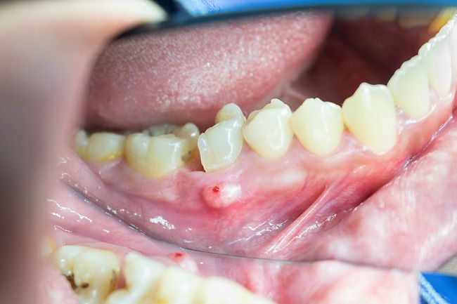 воспаление надкостницы зуба