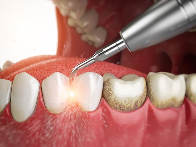 Воспаление десен после профессиональной чистки зубов