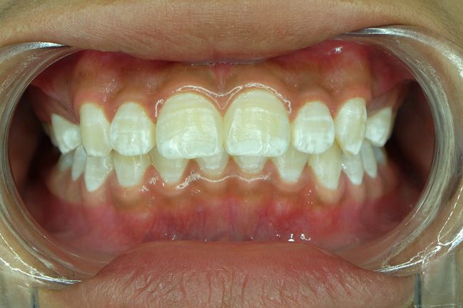 Микроабразия эмали зубов