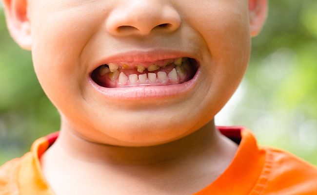 Почему у ребенка плохие зубы?