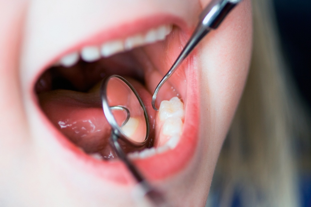методы профилактики кариеса зубов у детей