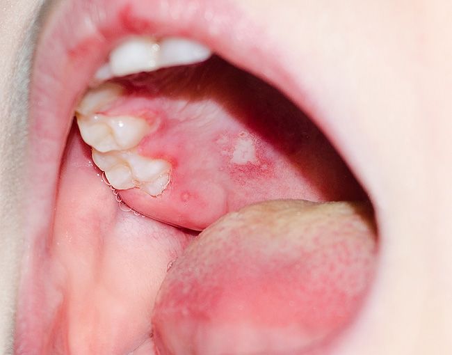Стоматит и другие воспаления слизистой полости рта у взрослых | Colgate®