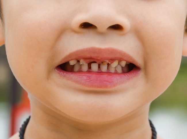 Спасаем крошащиеся зубы от разрушения
