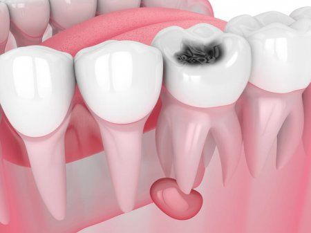 Болит зуб после удаления - что делать, сколько болит зуб