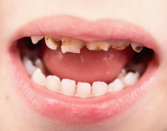 Дисплазия эмали молочных зубов