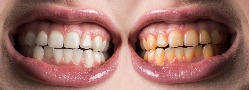Причина черного налета на зубах у взрослых причины лечение
